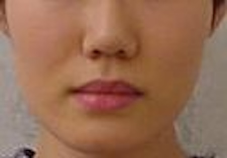 【矯正症例】ディープバイト、睡眠時無呼吸症候群が疑われた症例